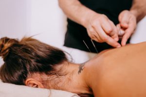 Acupuncture Fort Lauderdale, FL | Acupuncture Treatment | Acupuncture