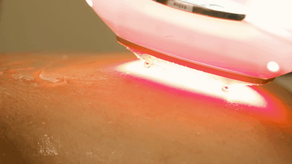 A close-up of a handheld device emitting a therapeutic red light onto a patient's skin to provide cold laser therapy at Spine and Joint Center in Fort Lauderdale.