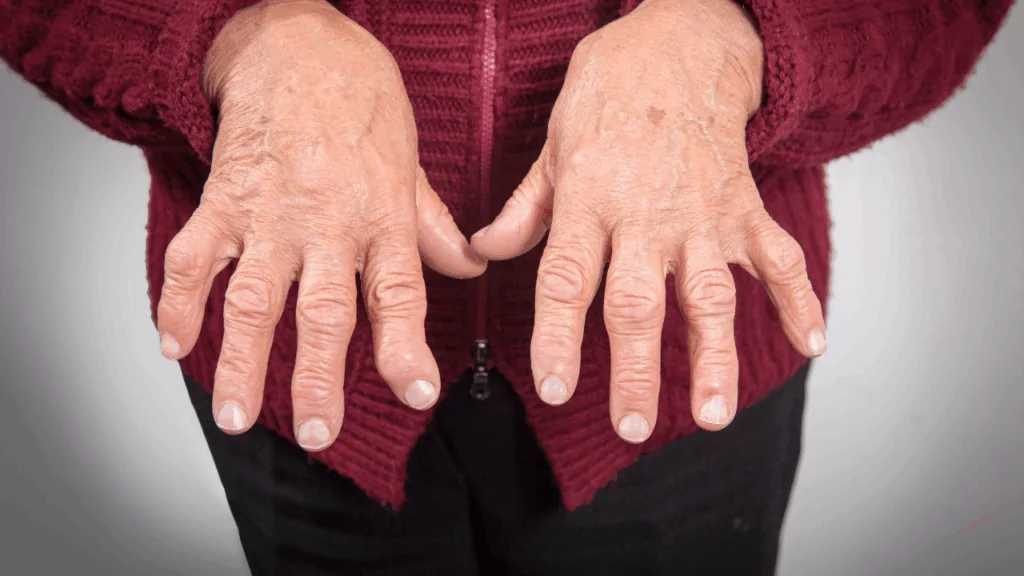 A close-up of a person's hands showing visible joint swelling and stiffness, symbolizing the need for specialized rheumatoid arthritis treatment at Spine and Joint Center in Fort Lauderdale.