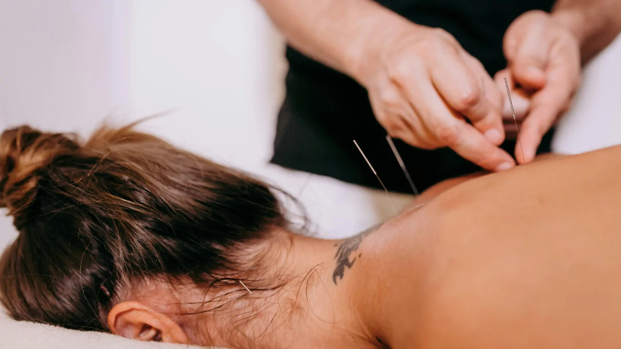 A clinician performing Dry Needling Therapy on a female patient's neck and upper shoulder area to relieve chronic tension and promote wellness in Fort Lauderdale.