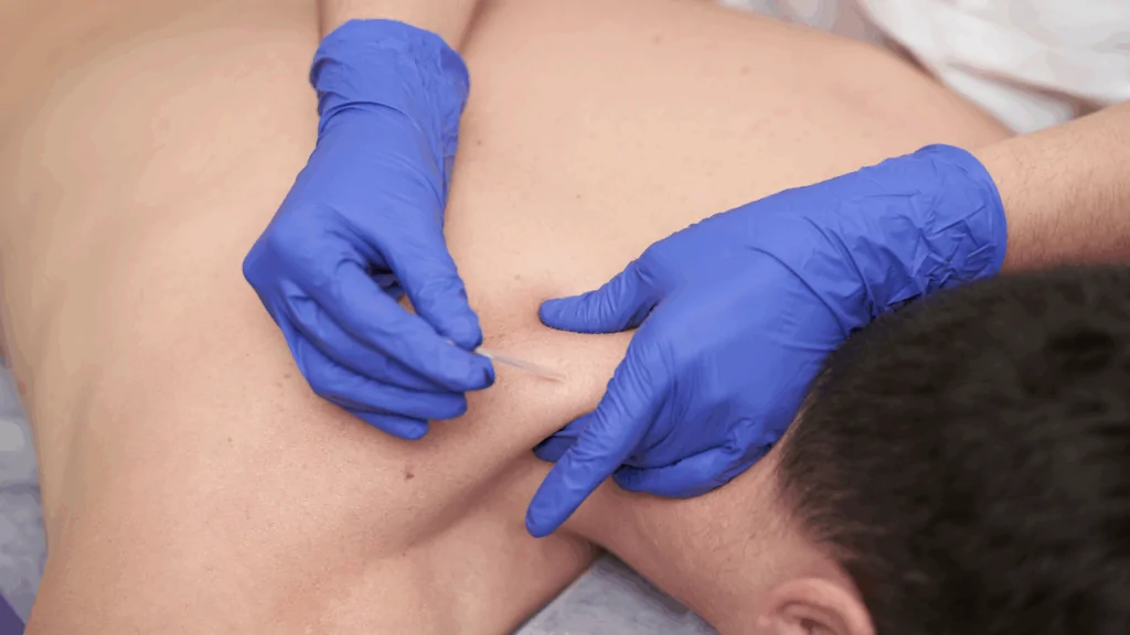 A clinician in blue gloves performing Dry Needling Therapy on a patient's upper back and shoulder area to release muscle knots in Fort Lauderdale.